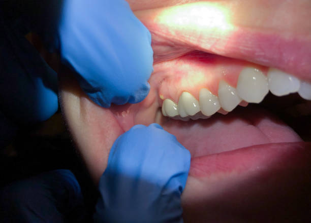 Best Emergency Root Canal Treatment in Franklin, WI